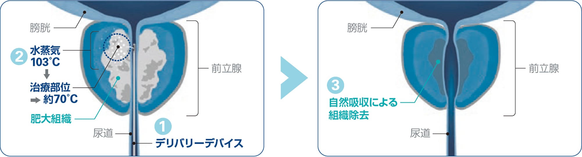 肥大組織とイラストと自然吸収による組織除去のイラスト