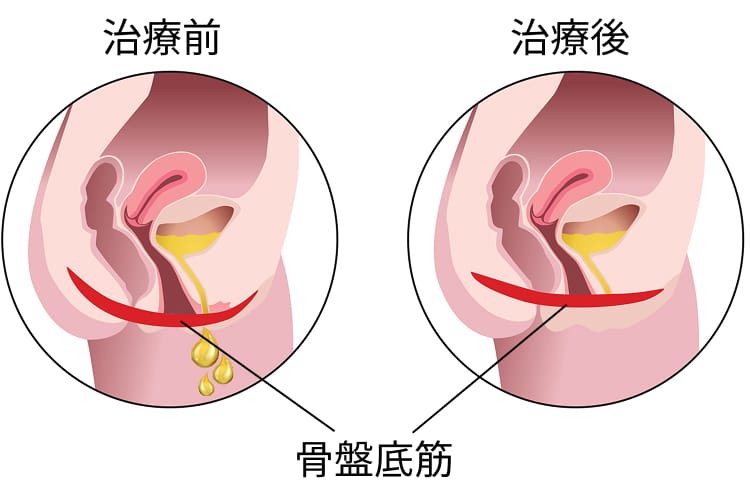 治療前後の骨盤の様子