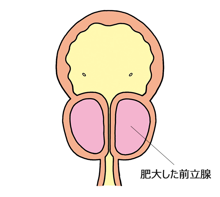 肥大した前立腺
