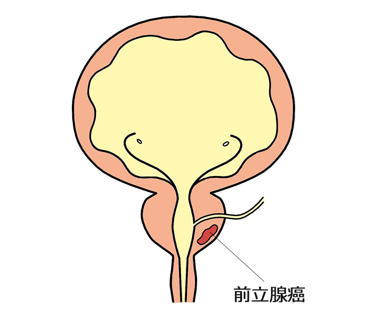 前立腺癌とは