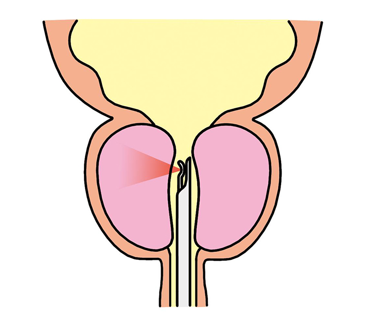 レーザーによる前立腺蒸散術