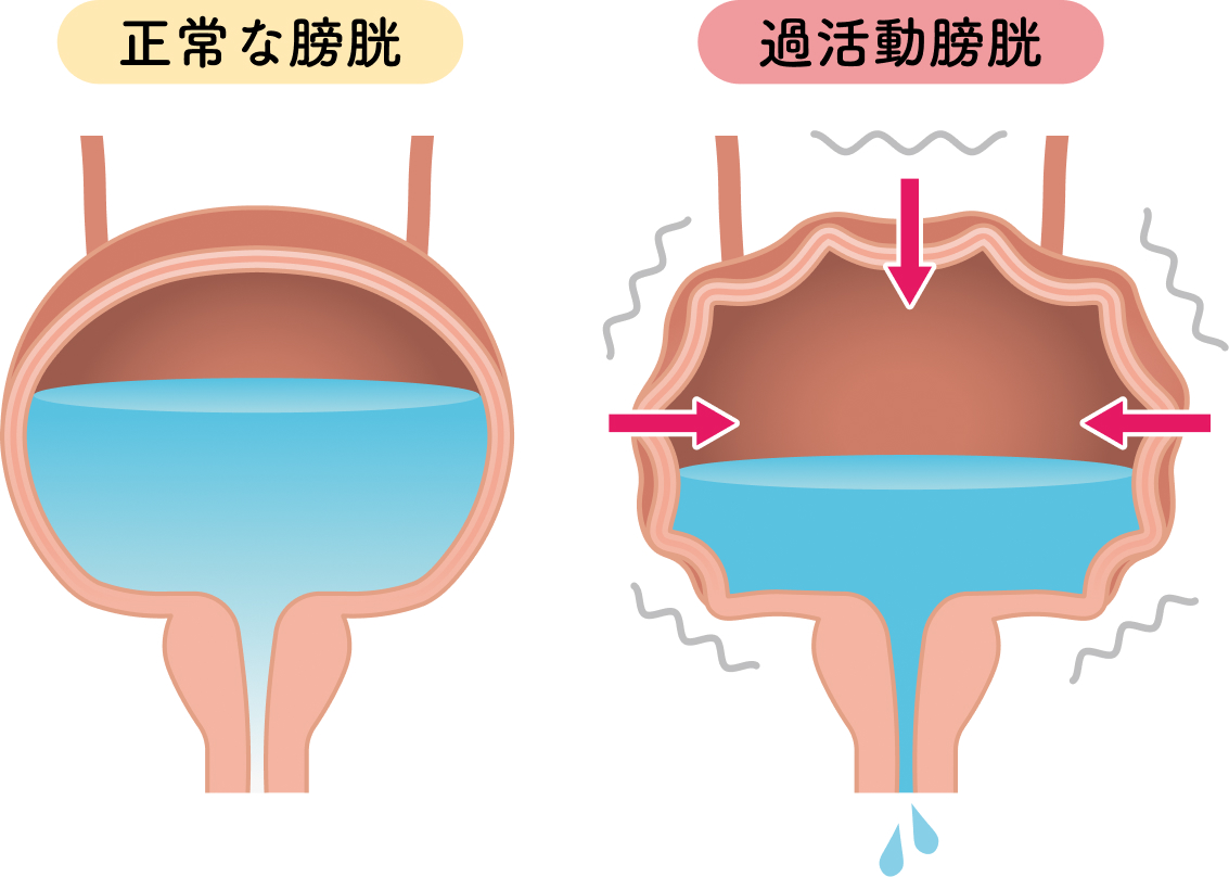 過活動膀胱のイラスト