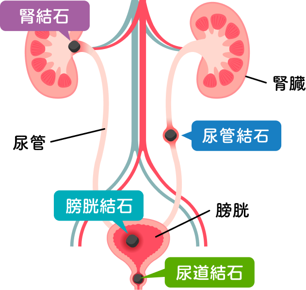 尿路結石のイラスト