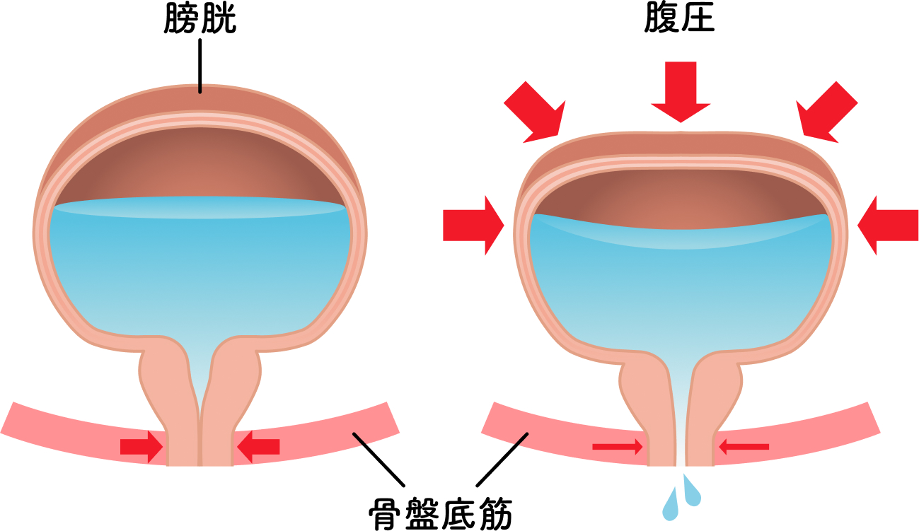 腹圧性尿失禁のイラスト