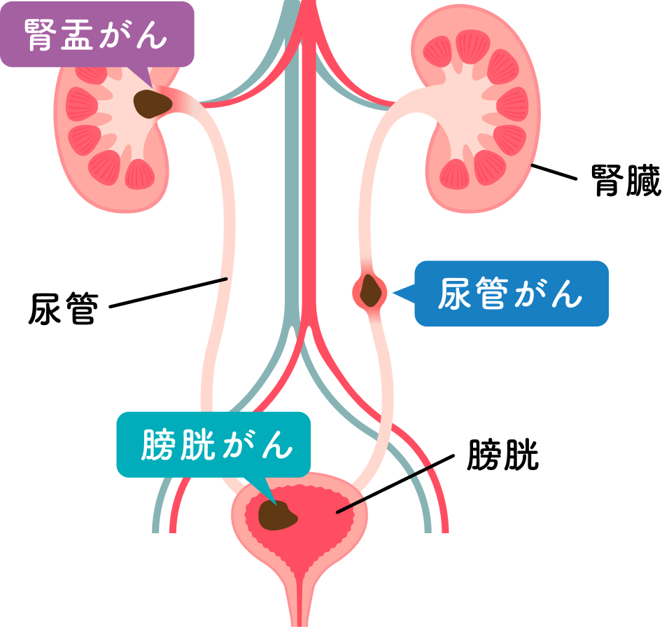 悪性腫瘍のイラスト
