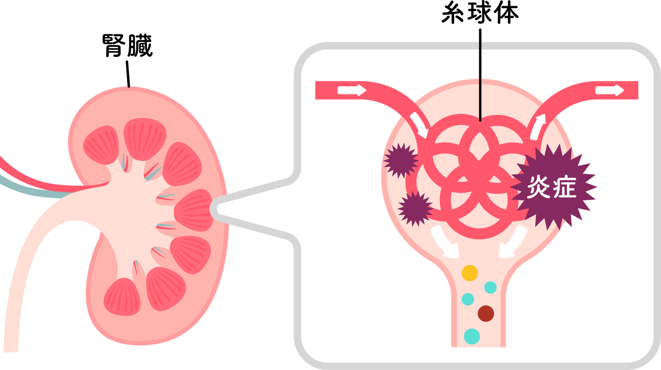 炎症糸球体腎臓のイラスト